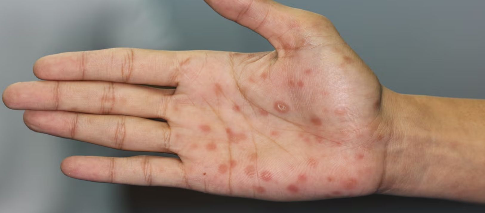 Imagen de la noticia: Alerta por sífilis: los casos alcanzan cifras récord en la Argentina